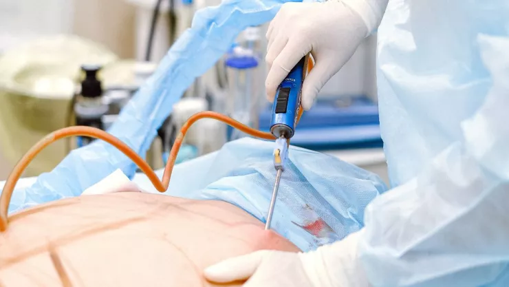 Liposucción cirugía estética