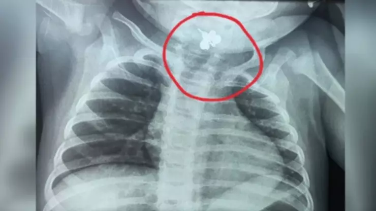 Bebé de 10 meses aspiró un anillo: el diagnóstico tardío que pudo terminar en tragedia