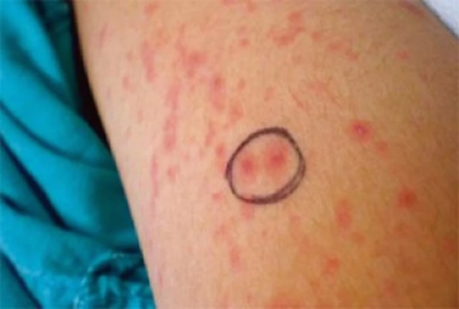 Dermatitis NTX.jpg