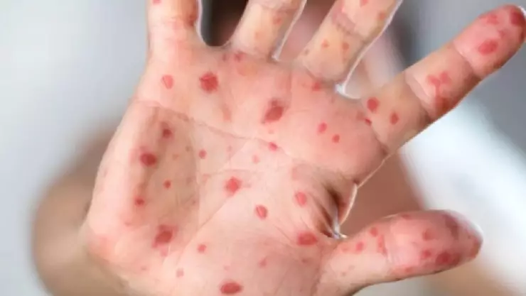 ¡Tragedia! Confirman la MUERTE de bebé de 1 año por SARAMPIÓN; 7 niños de la misma familia están CONTAGIADOS