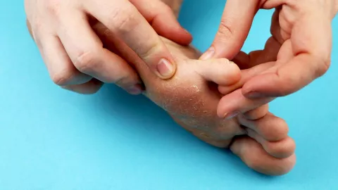 Los hongos pueden hacerle mucho daño a la salud de nuestros pies: es fundamental controlarlos periódicamente.