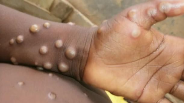 La OMS declara emergencia sanitaria por viruela del mono