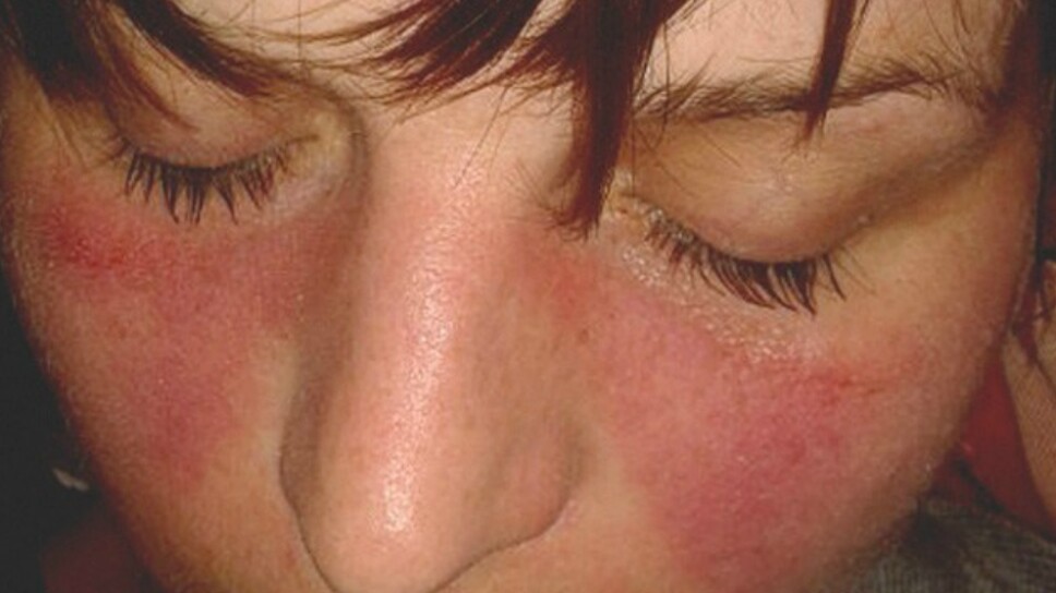 Lupus