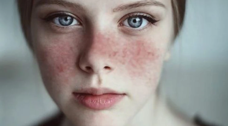 Lupus