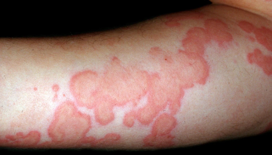 00001urticaria.jpg