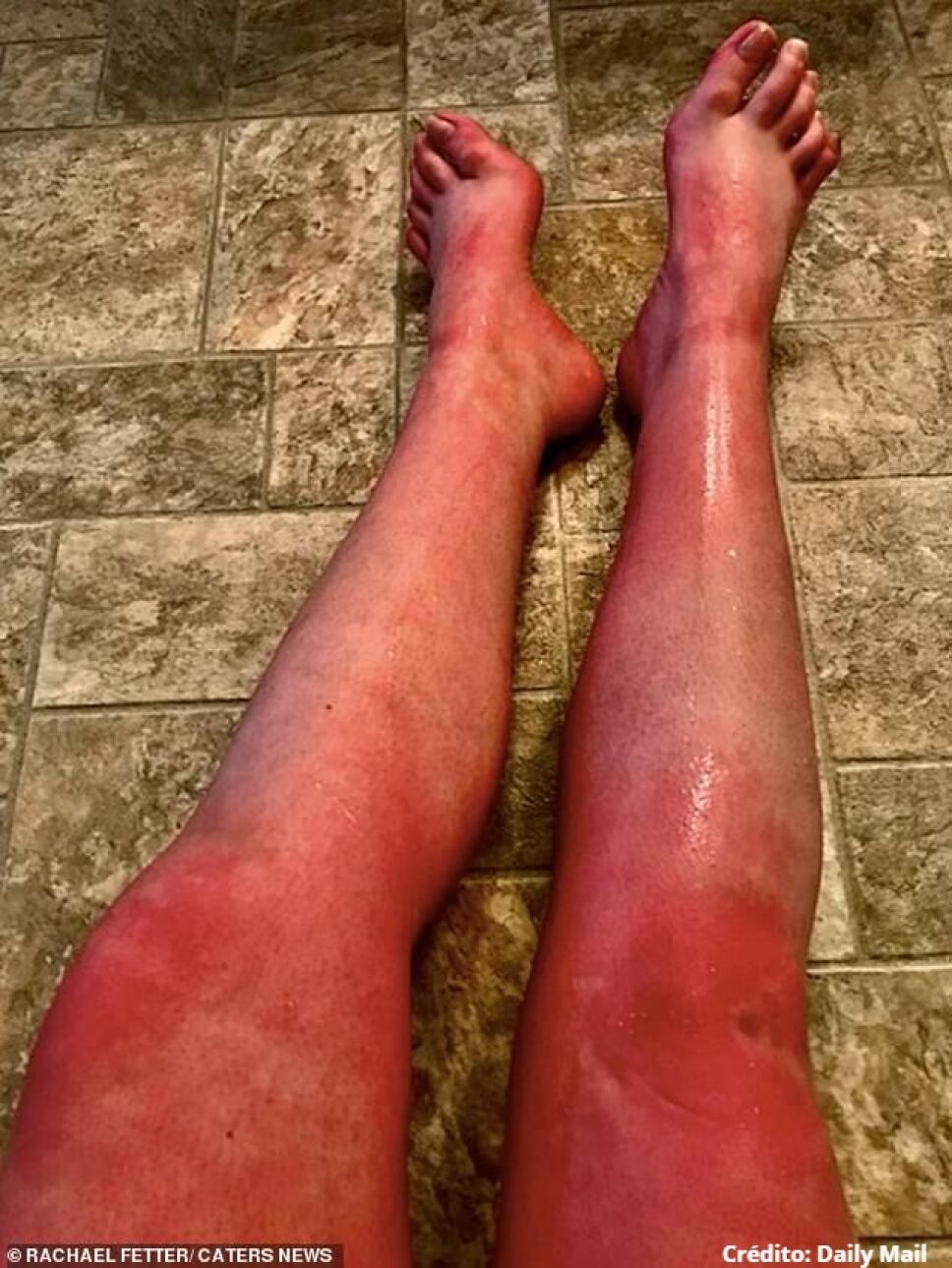 Joven sufre alergia al agua