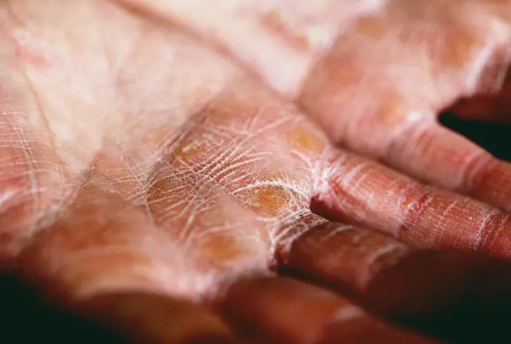 ¿Cómo cuidar la piel seca?