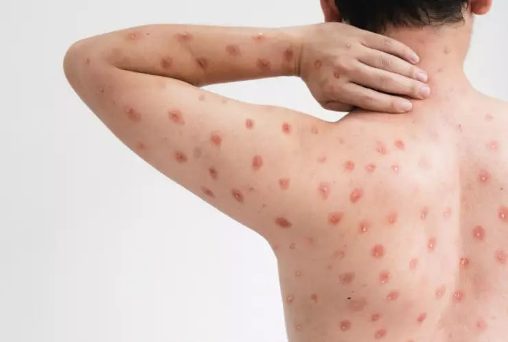 Viruela de mono: Síntomas de la cepa que mantiene en alerta a la OMS por su expansión