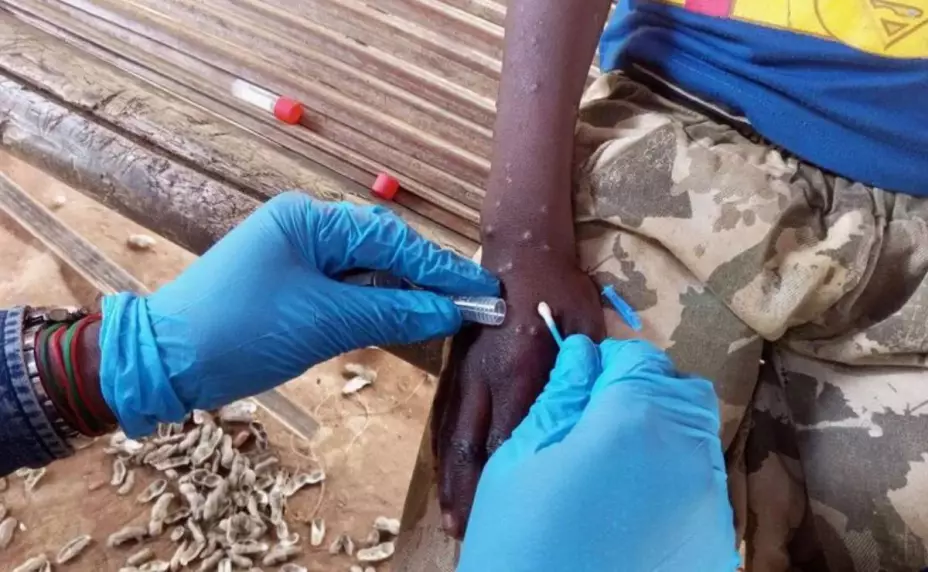 Reportan hasta 7 casos de VIRUELA DEL MONO en la Península de Yucatán