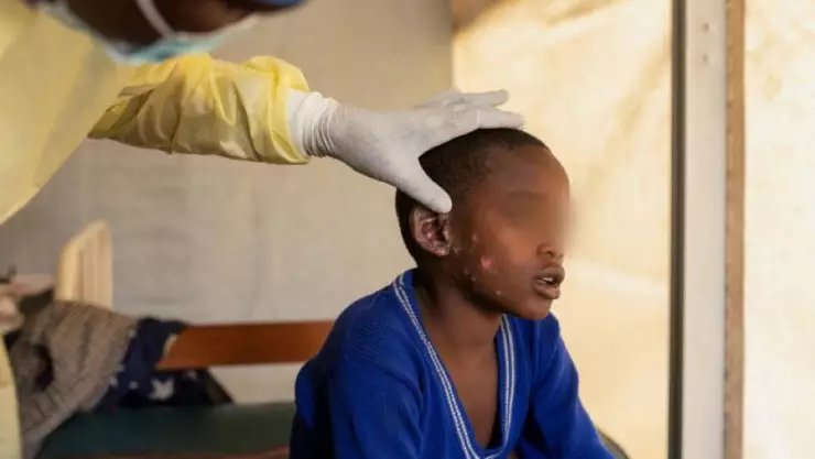 ÚLTIMA HORA_ La OMS declara “emergencia de salud pública” por brote de viruela símica