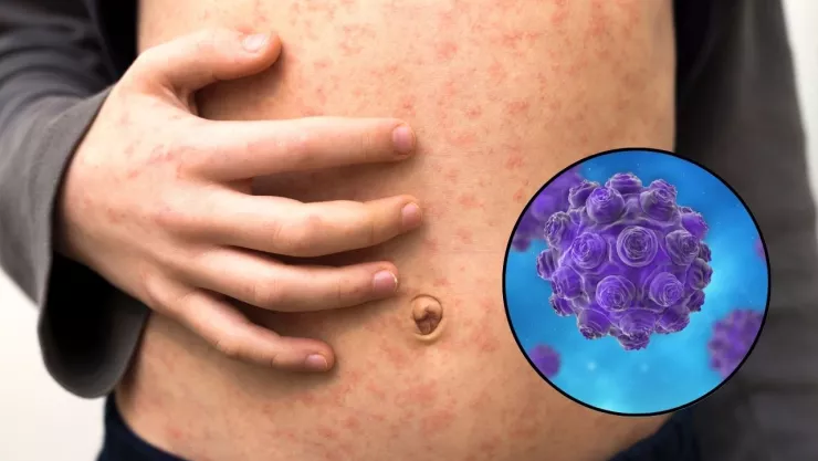 sarampión en México.jpg