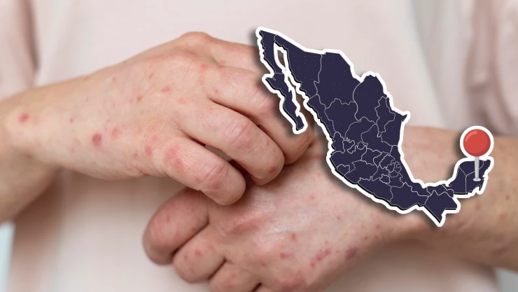 Confirman autoridades 70 casos de sarampión en Quintana Roo: ¿Cuántos casos se han acumulado en el estado?