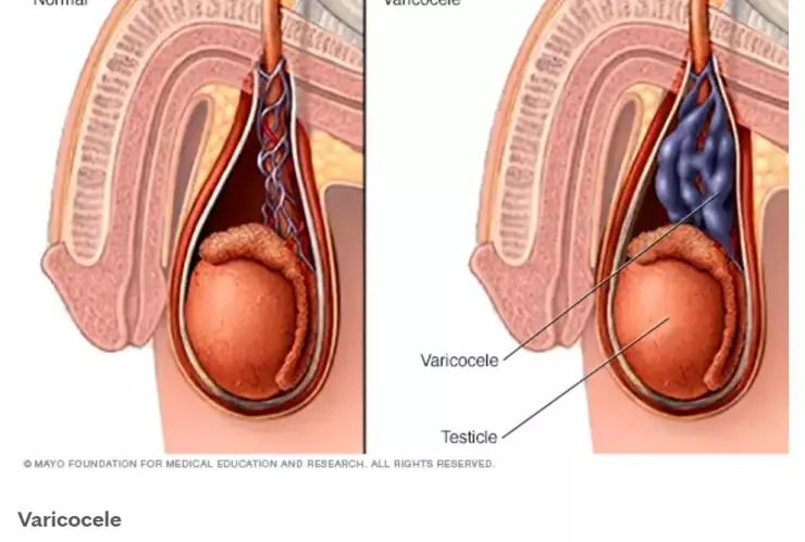 Varococele-qué-es-enfermedad-hombre-pareja-tuvo-relaciones-cablebús-Ecuador