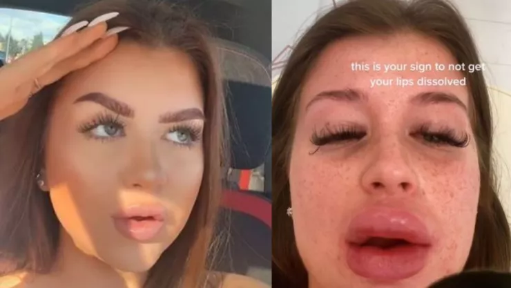 Karli gardener la joven que se desfigura la cara tras aplicarse ácido hialurónico sintético en los labios.jpg