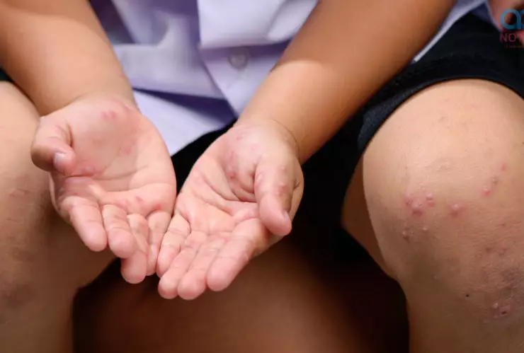 Virus Marburgo: OMS anuncia nuevos casos por propagación, estos son los síntomas