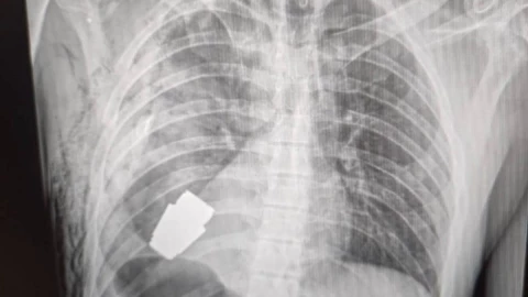 Cirujanos extirpan granada del pecho de un soldado