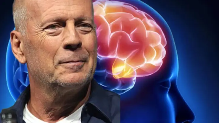 ¿Qué esperanza de vida tiene una persona con la enfermedad de Bruce Willis?