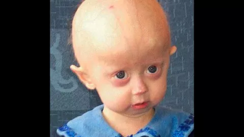 Progeria, joven, anciana c.jpg