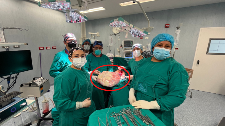 Tumor de 20 kilos