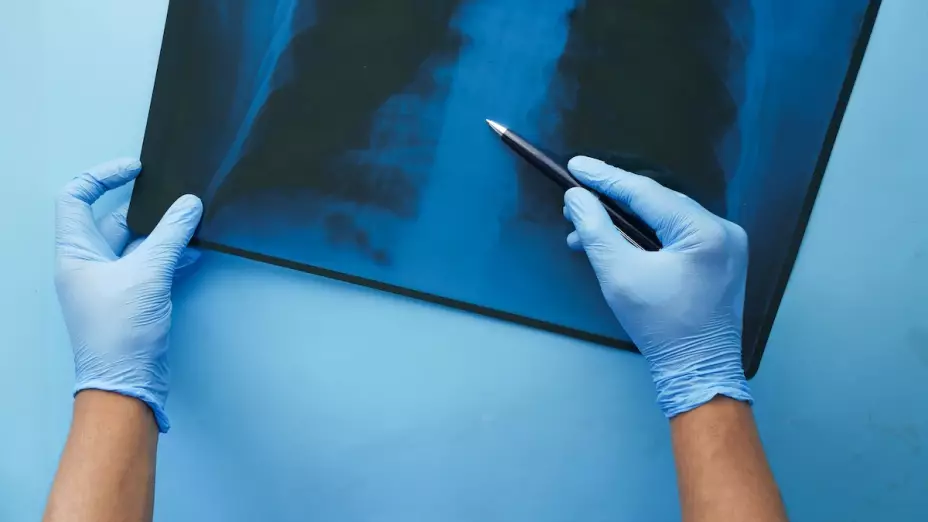 Fracturas más comunes