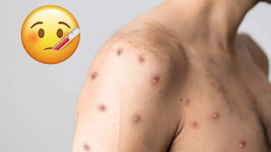 viruela del mono veracruz.jpg