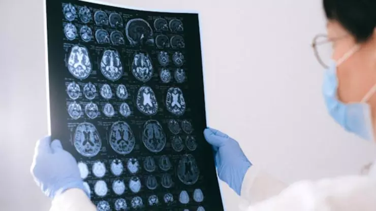 Científicos observan el Alzheimer en tejido cerebral y en tiempo real, ¿qué significa?