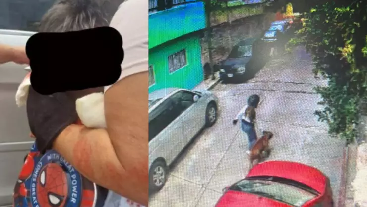 Perro pitbull ataca a niño de 5 años y le arranca el cuero cabelludo (IMÁGENES FUERTES)