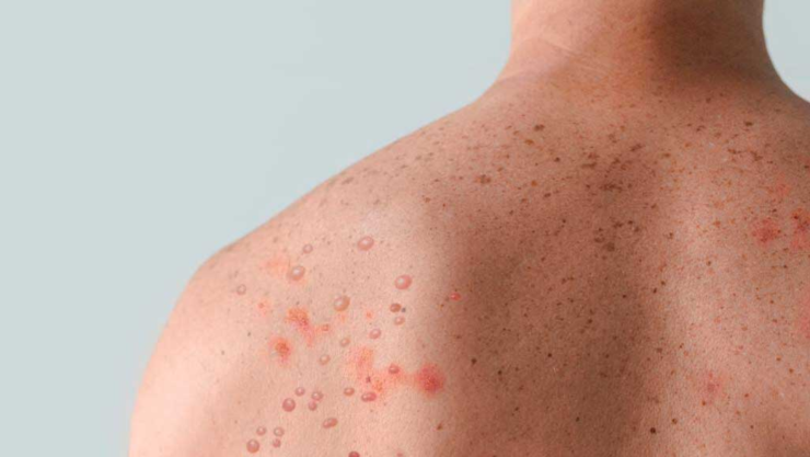 Sarampión en Chihuahua