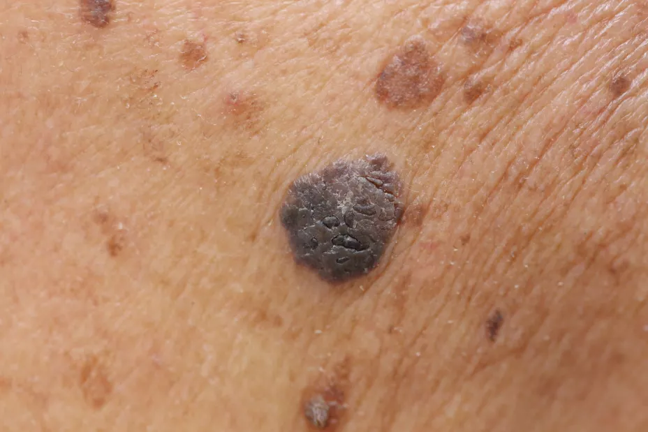 Melanoma l-Charnsit Ramyarupa (1).jpg