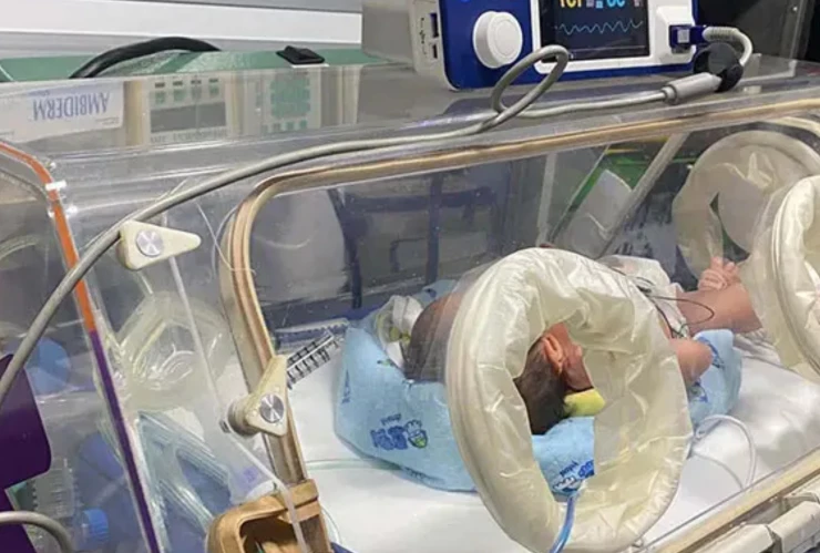 bebé broncoaspiración