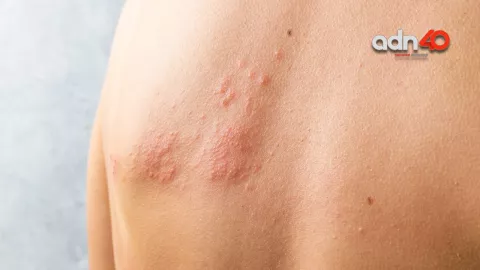 ¿Qué es la culebrilla? Enfermedad relacionada con el herpes zóster