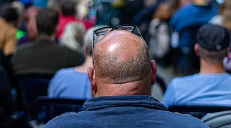 alopecia covid-19 .jpg