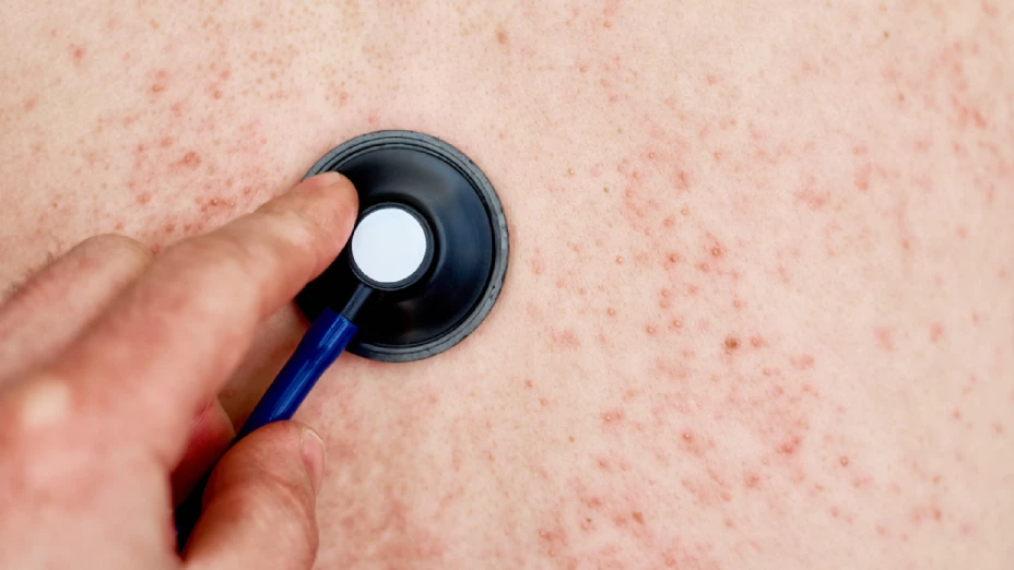 sarampión en Chihuahua.jpg