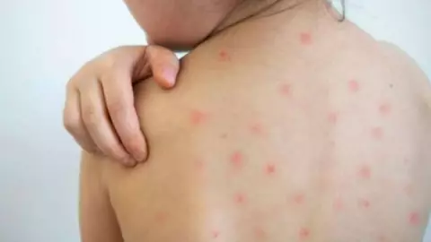 ¿Qué es el sarampión y cuáles son los síntomas de esta enfermedad?