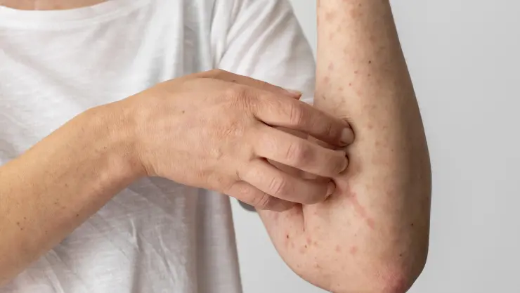 ¿A qué edad hay que ponerse la vacuna contra el sarampión?