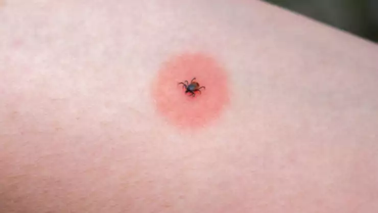 Enfermedad de chagas.