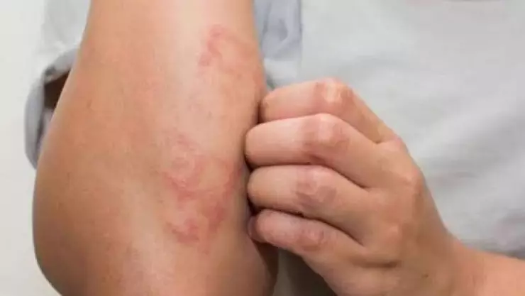 Aumentan casos de lepra en 12 municipios; SSA mantiene vigilancia