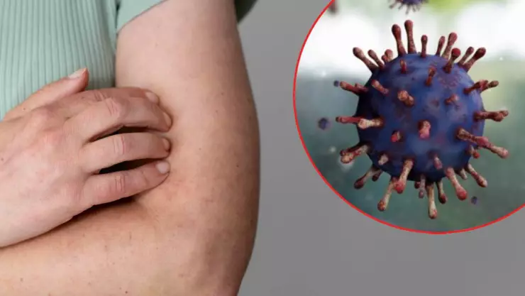 Sarampión en superficies