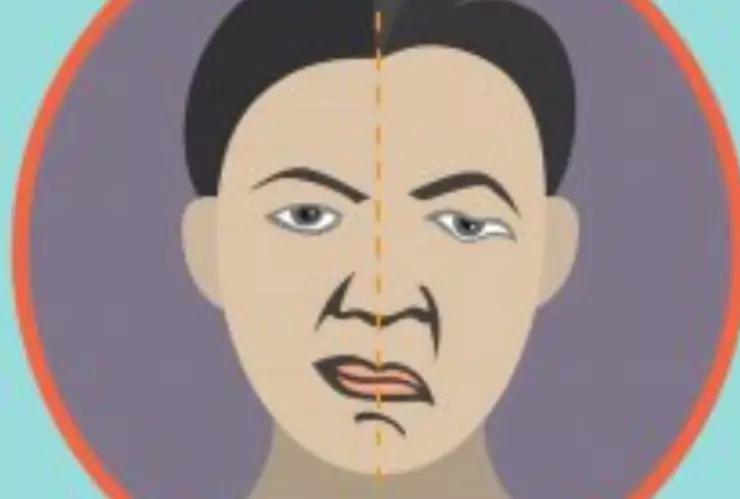 paralisis facial