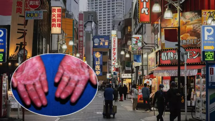 ¡Hay alerta! Japón registra un aumento en casos de infección mortal; esto debes saber