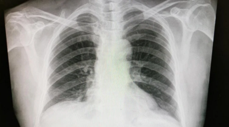 cáncer de pulmón ISSSTE inmunoterapias