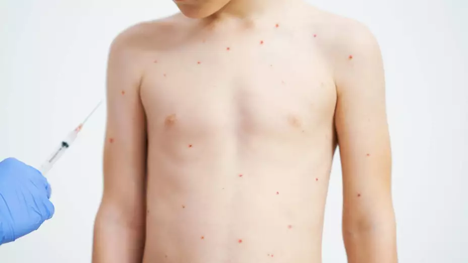 sarampión en Cuauhtémoc