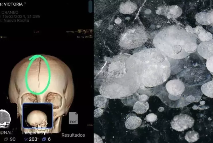 FOTO_ Niña resulta con fractura craneal tras ser golpeada por el granizo que cayó