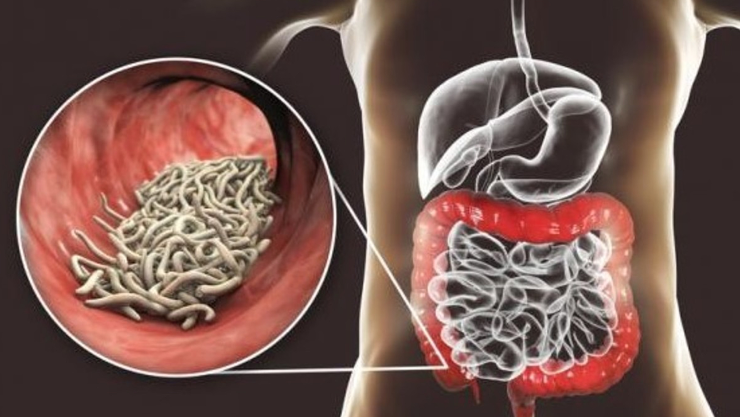lombrices en niño chiapas.jpg