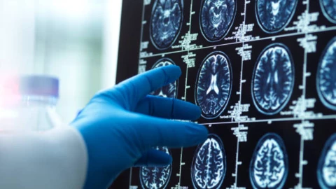 Muere Arden Yarham joven con demencia y dona cerebro a la ciencia.png