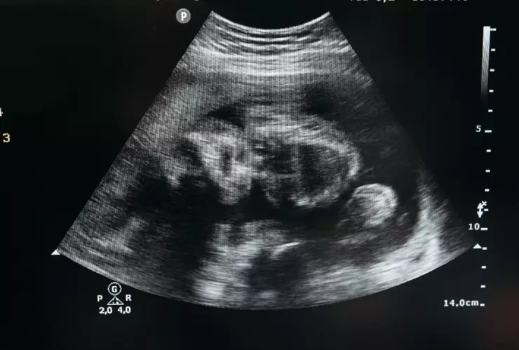 Doctores encuentran fetos en el vientre de una bebé recién nacida