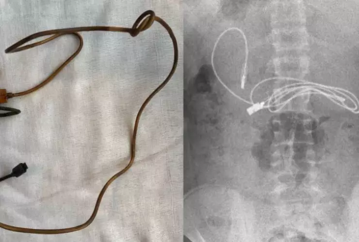 Menor fue al doctor por dolor estomacal; tenía cable USB en el colon