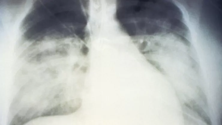 AP Chest X-Ray
