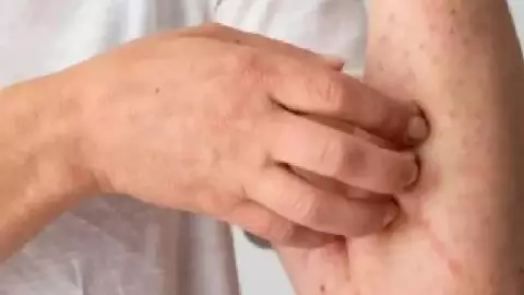 Aumento de casos de sarampión: ¿Qué tan peligroso es para los ADULTOS mayores de 40 años?