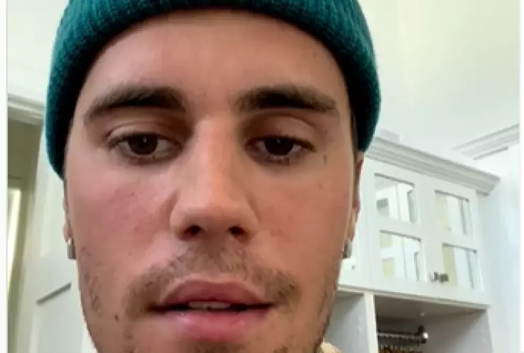 justin biebier par&aacute;lisis facial